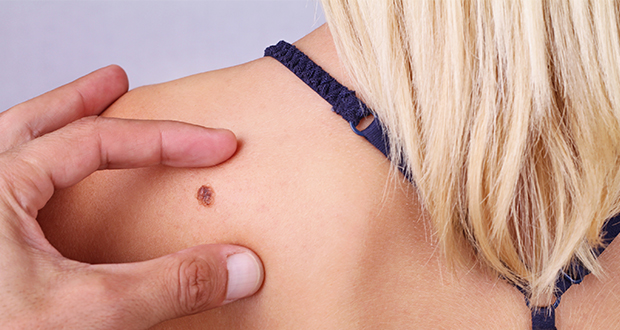 melanoma2