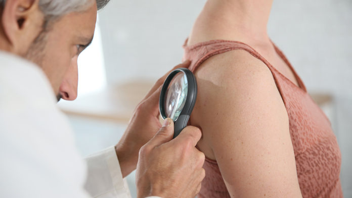 melanoma3